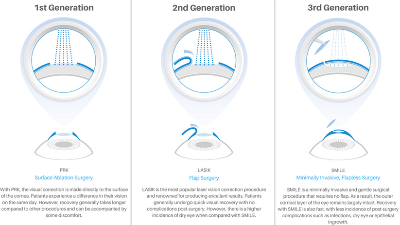 infographic with details about surgery generations of laser eye surgery. PRK / LASIK / SMILE