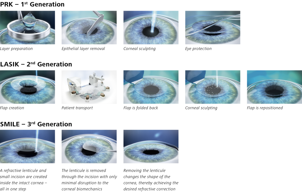 Laser Eye Surgery Options