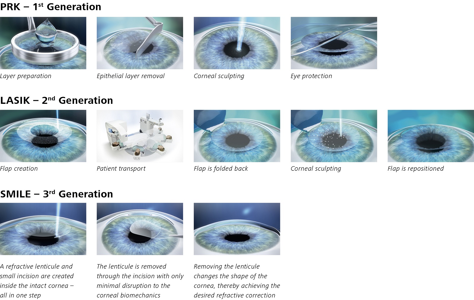 LASIK vs SMILE Laser Eye Surgery