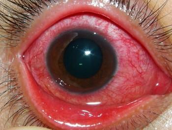 Contact Lens Complications