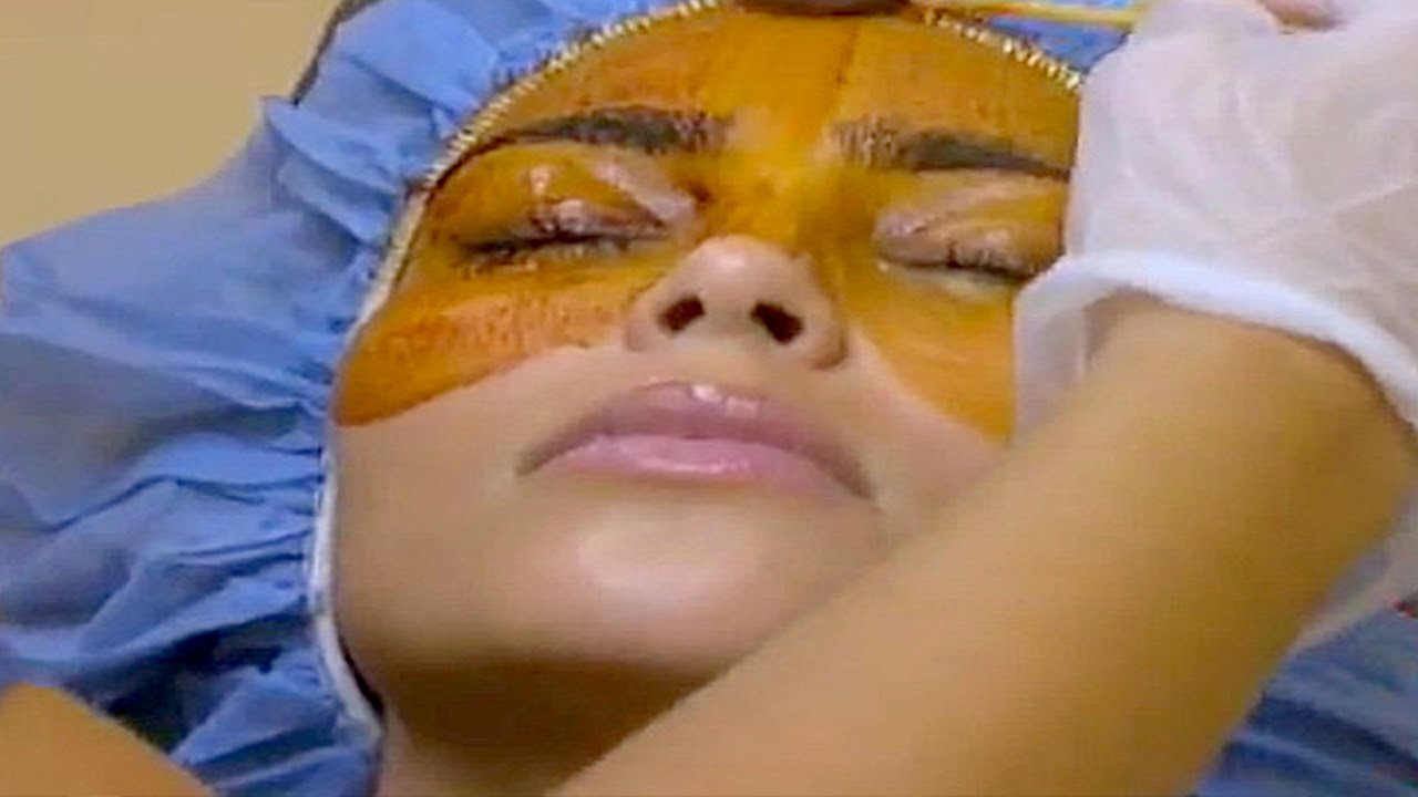 Kim Kardashian LASIK SMILE celebrity laser eye surgery