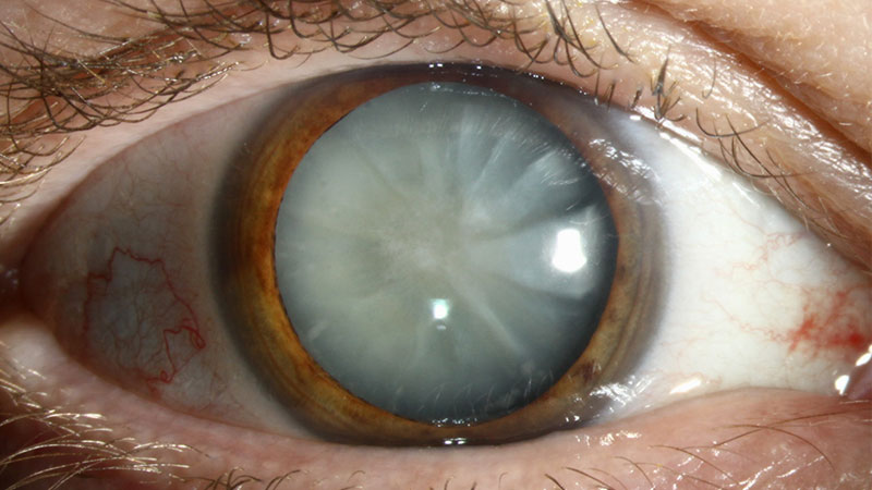 3 Different Types of Cataracts