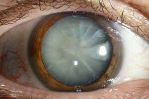 common cataract questions