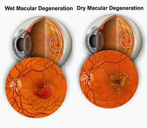 dry vs wet macular degeneration