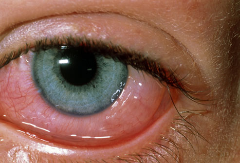 conjunctivitis