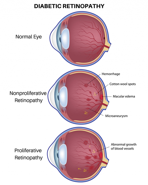 diabetic retinopathy