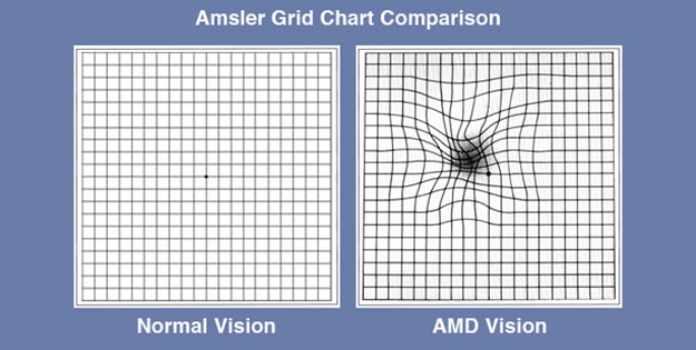 Amsler Grid Chart Comparison