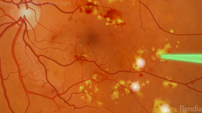 Laser being applied to retina