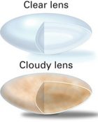 cloudy lens vs clear lens cataract