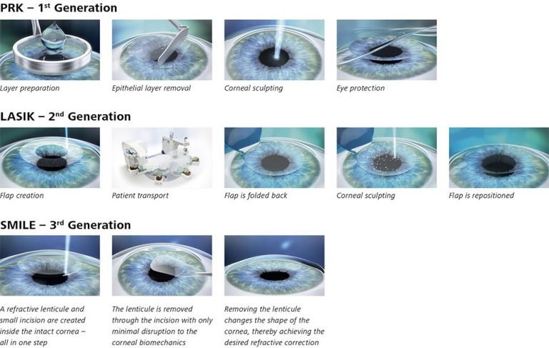 The Difference Between SMILE & LASIK Laser Eye Surgery