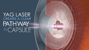 Image that says 'YAG laser creates a clear pathway in capsule'