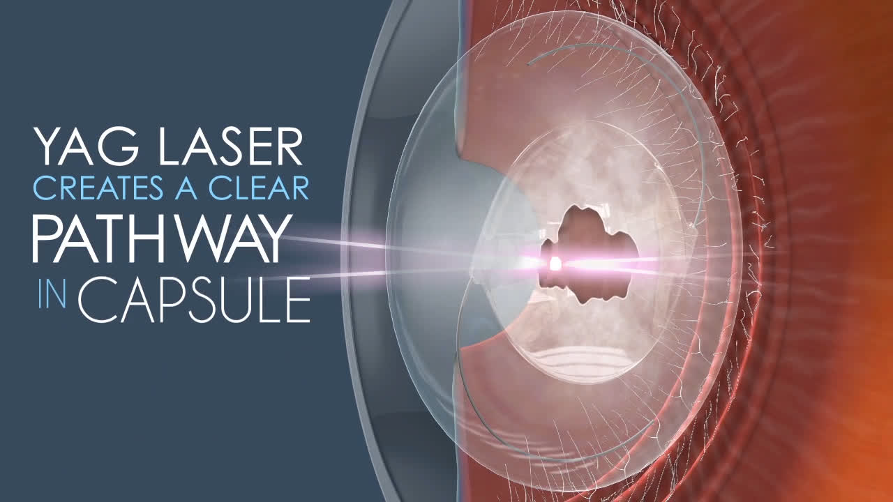 Yag Laser Treatment Following Cataract Surgery Insight Eye Clinic