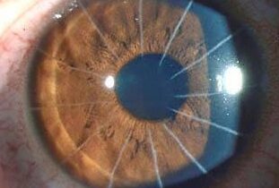 an eye after radial keratotomy surgery (RK)