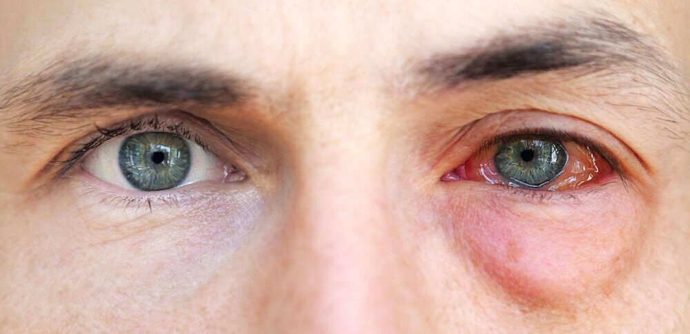 5 Things to Know About a Black Eye - American Academy of Ophthalmology