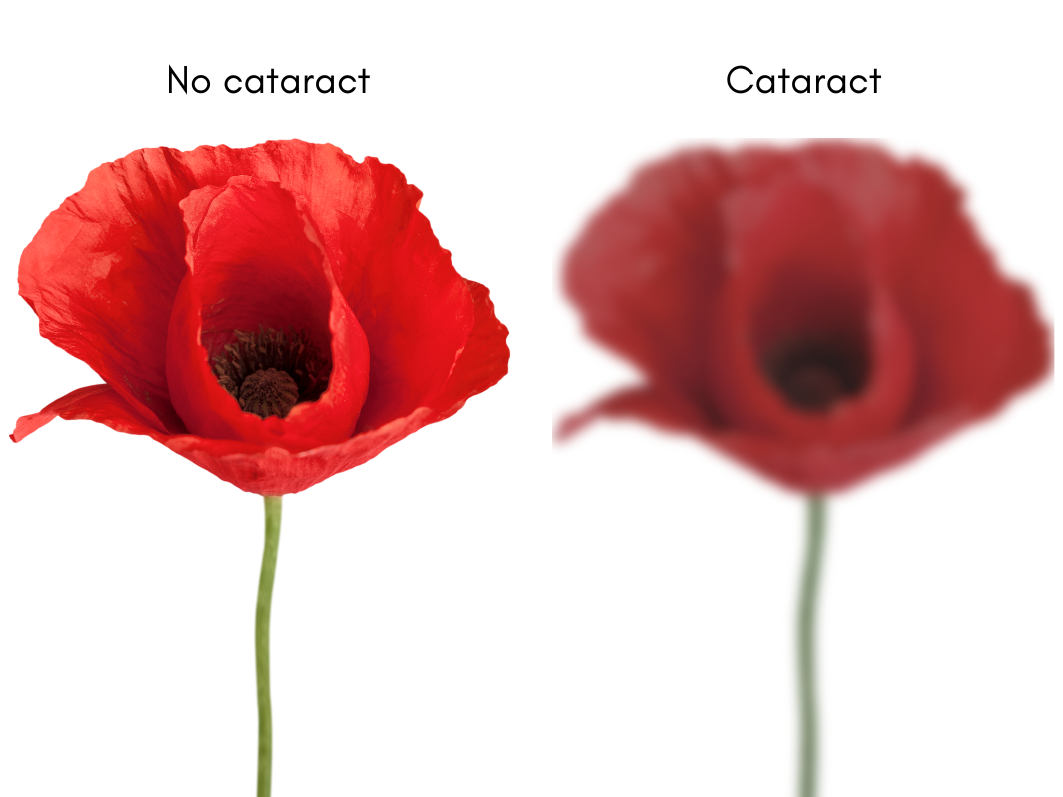 Vision with cataract vs no cataract