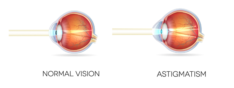 image showing an eyeball with normal vision and another eyeball with astigmatism