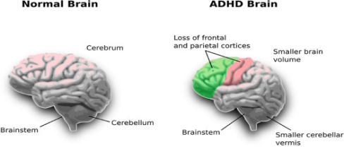 Image showing 2 brains. 1 is classed as normal and the other as having ADHD