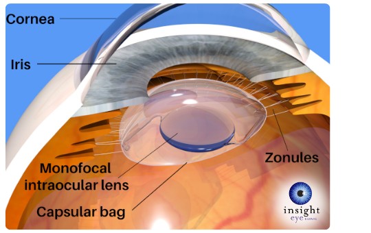image showing IOL positioning within eye