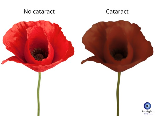cataract effect vision