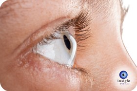 Eye with Keratoconus CANVA