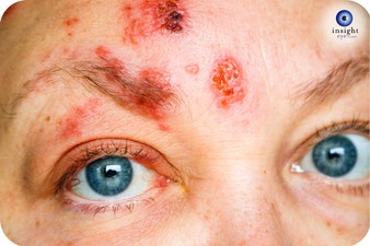 Shingles - CANVA