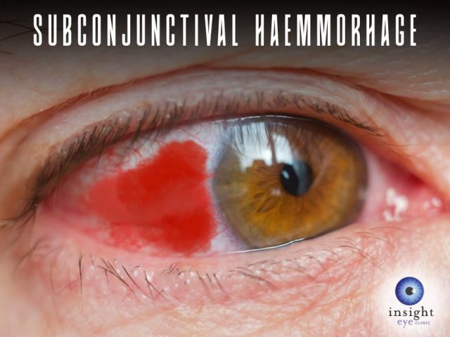 Subconjunctival Haemorrhage 