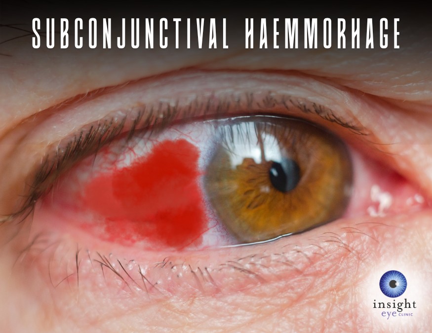 Subconjunctival Haemorrhage