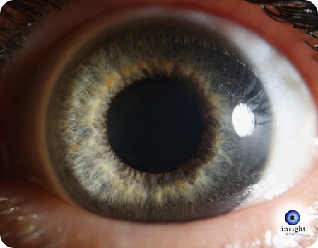 effects dilating eye drops 